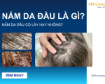 NẤM DA ĐẦU LÀ GÌ? CÓ NGUY HIỂM HAY KHÔNG?