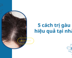 Cách trị gàu cho nữ tại nhà hiệu quả: Tạm biệt “tuyết rơi” sau 2 tuần