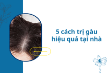 Cách trị gàu cho nữ tại nhà hiệu quả: Tạm biệt “tuyết rơi” sau 2 tuần